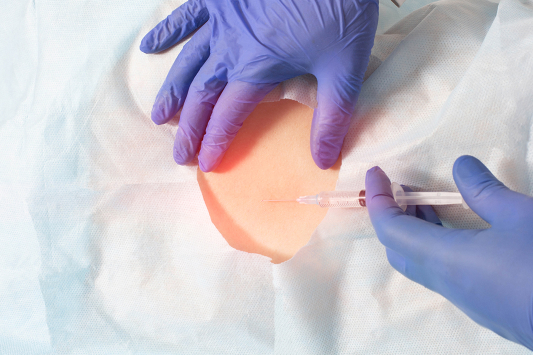 THERAPEUTIC LOCAL  INJECTIONS